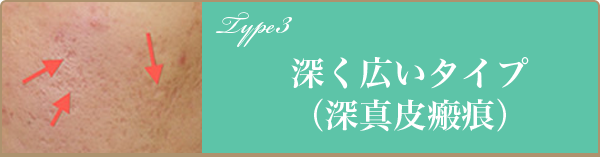 深く広いタイプ（深真皮瘢痕）