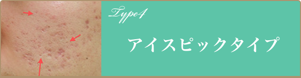 アイスピックタイプ