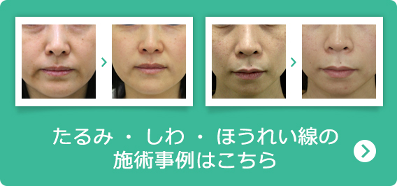 たるみ・しわ・ほうれい線の施術事例はこちら