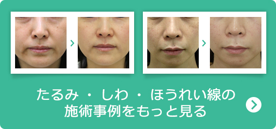 たるみ・しわ・ほうれい線の施術事例はこちら