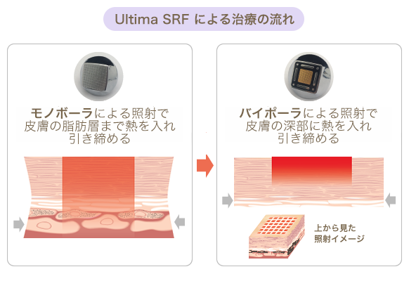 Ultima SRFによる治療の流れ