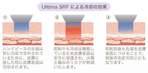 Ultima SRFによる冷却の効果