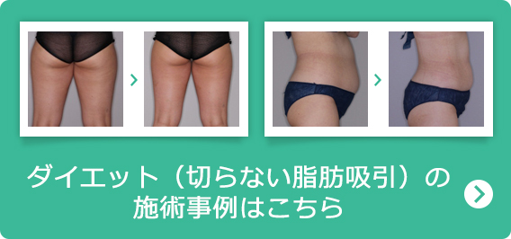 ダイエット（切らない脂肪吸引）