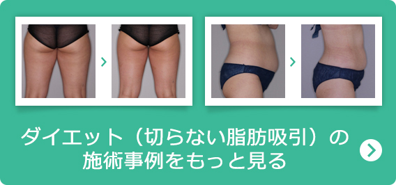 ダイエット（切らない脂肪吸引）