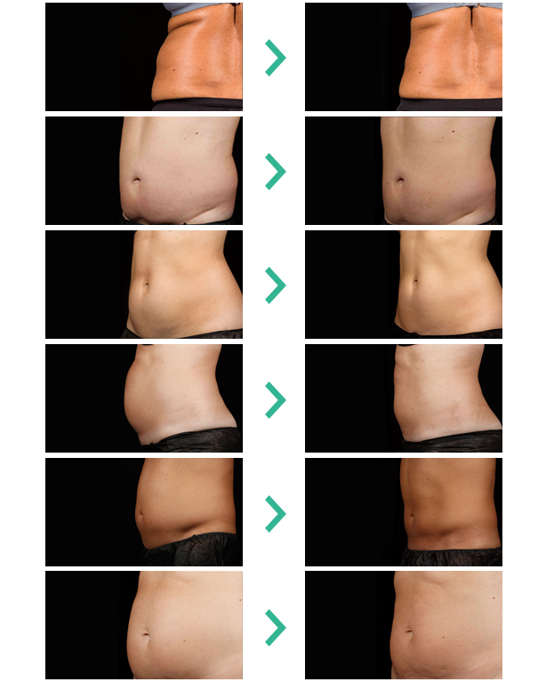 beforeafter