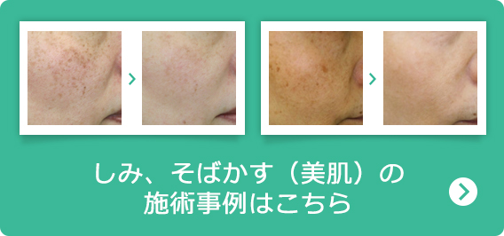 しみ、そばかす（美肌）の施術事例