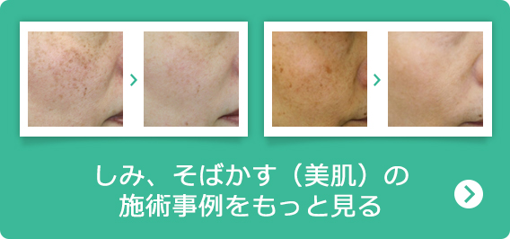しみ、そばかす（美肌）の施術事例をもっと見る