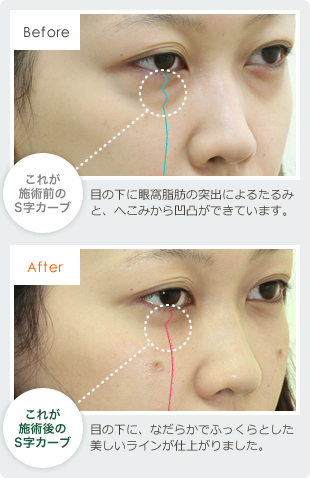 目の下のクマ、膨らみ、たるみ症例画像