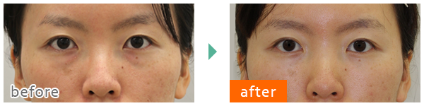 beforeafter