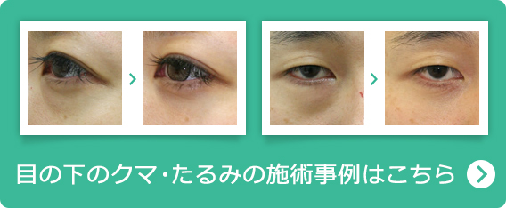 目の下のくま・たるみの施術事例